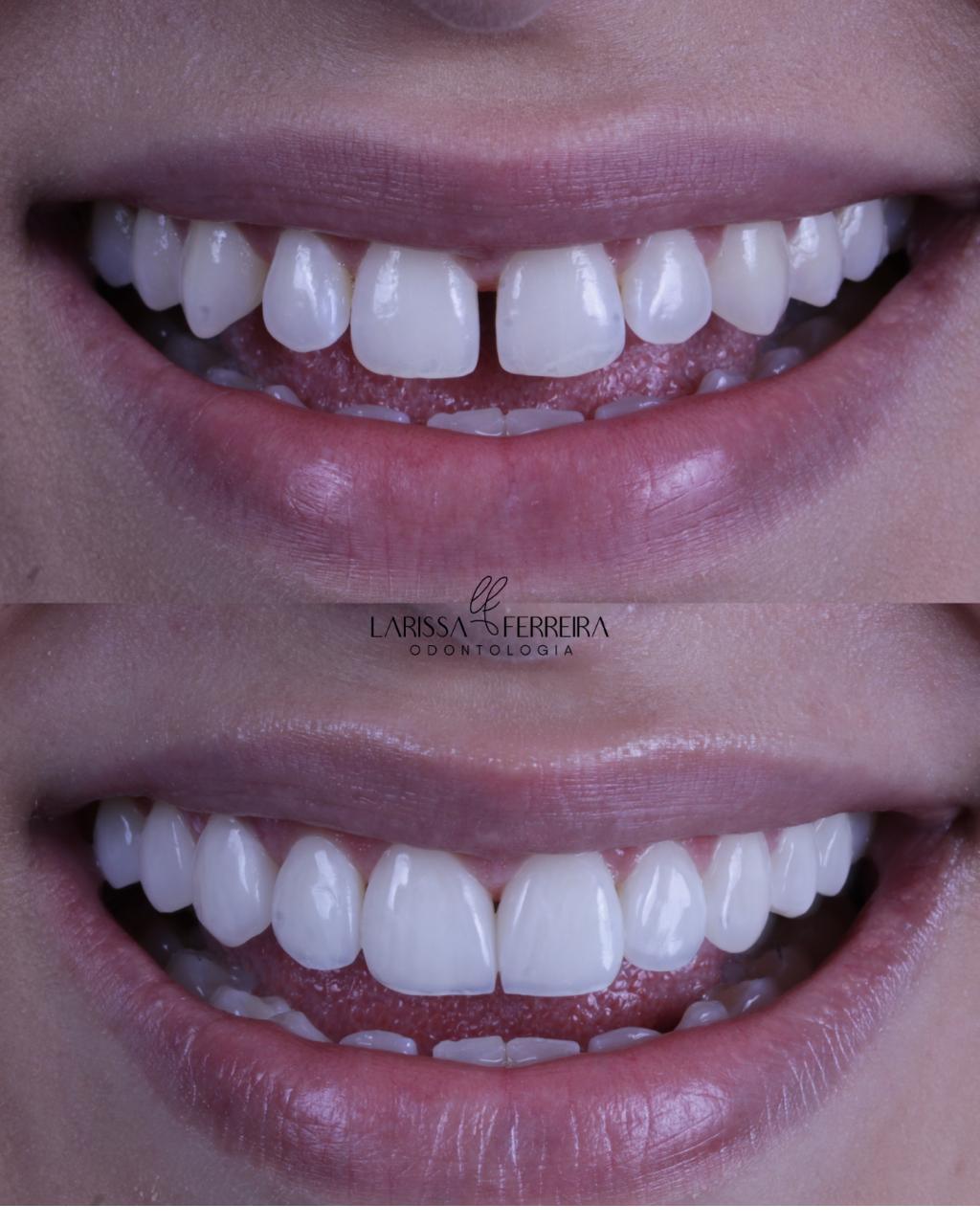 Transformação de sorriso — caso 1