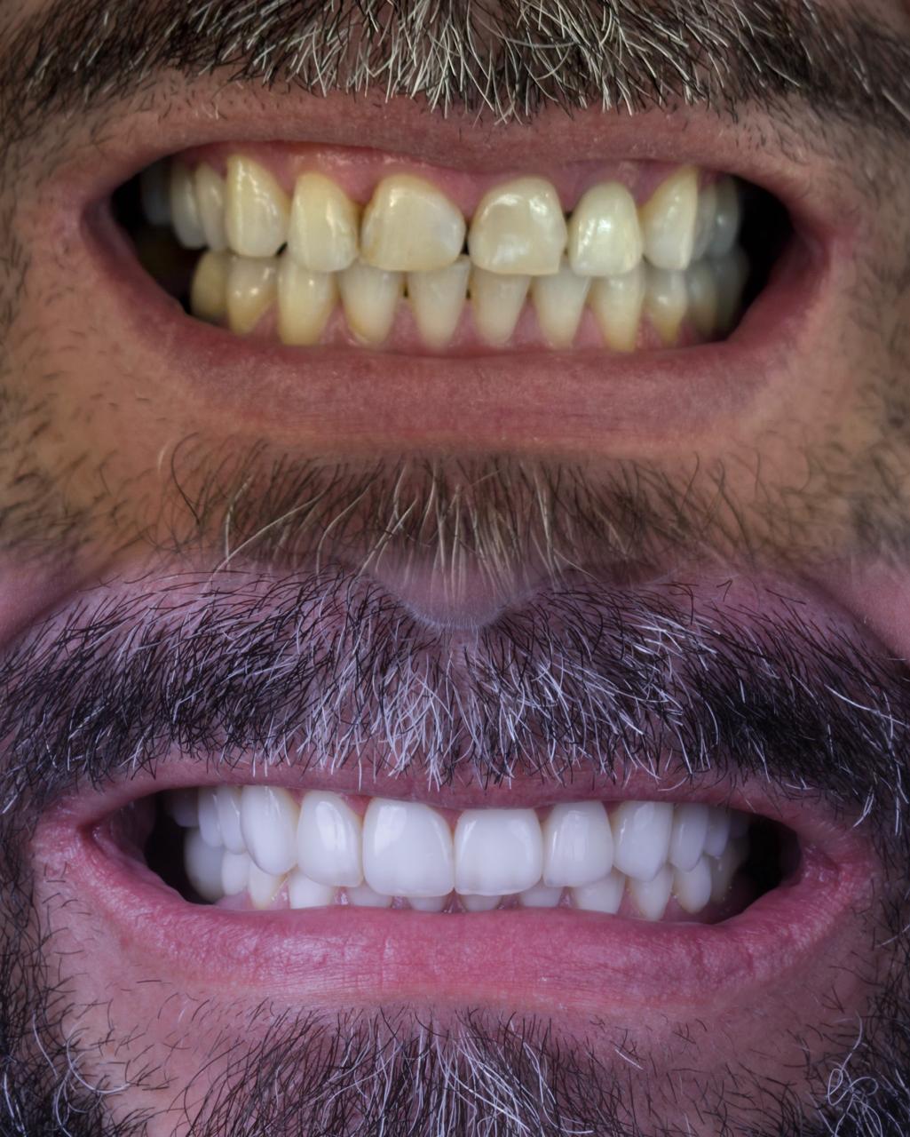 Transformação de sorriso — caso 4