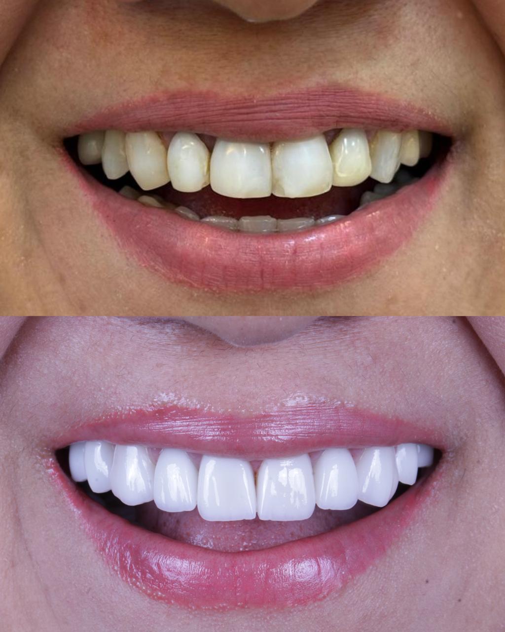 Transformação de sorriso — caso 2