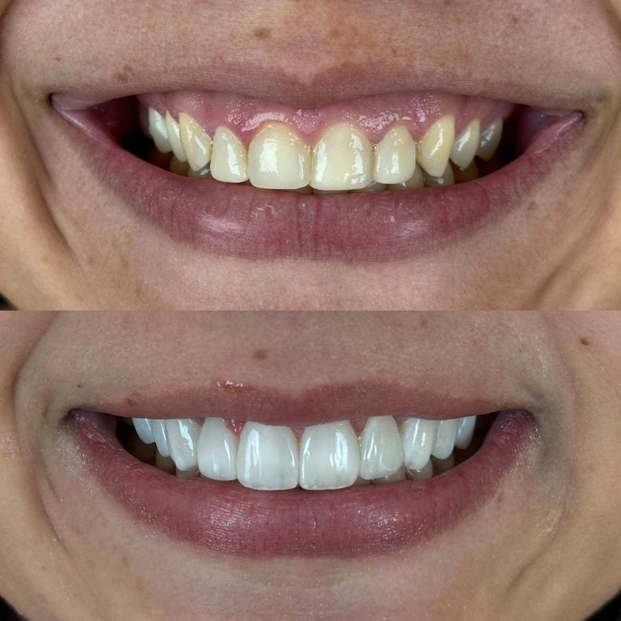 Transformação de sorriso — caso 3